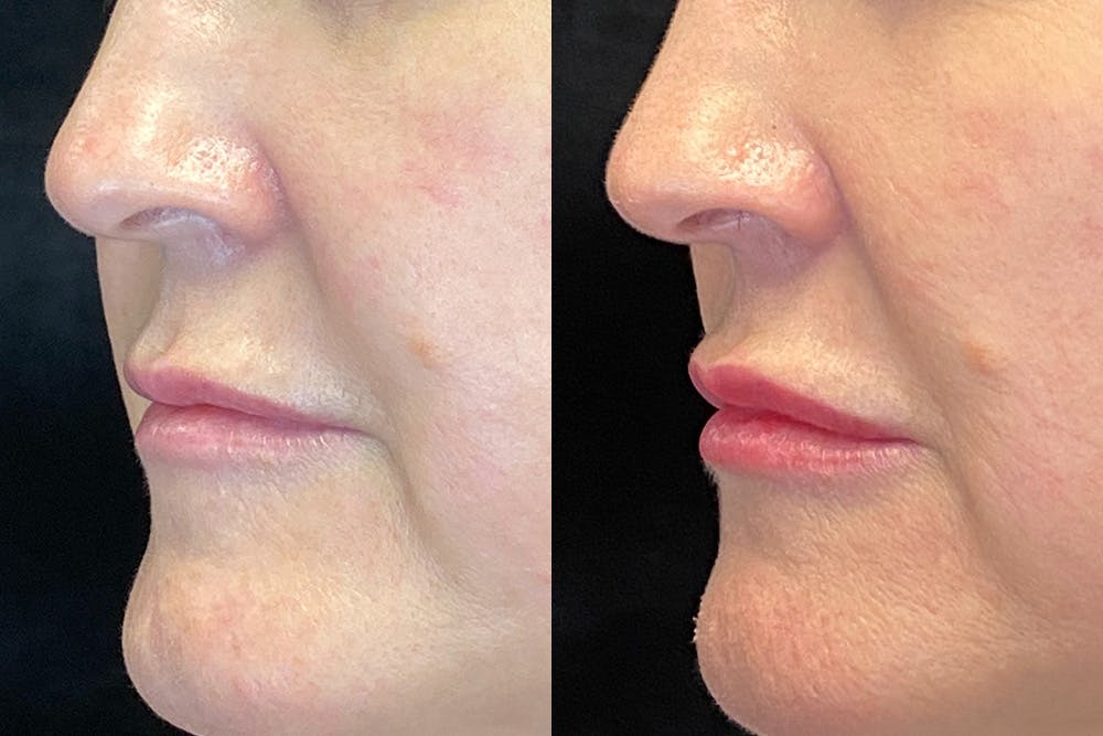 Dermal Fillers Before & After Gallery - Patient 144315044 - Image 3