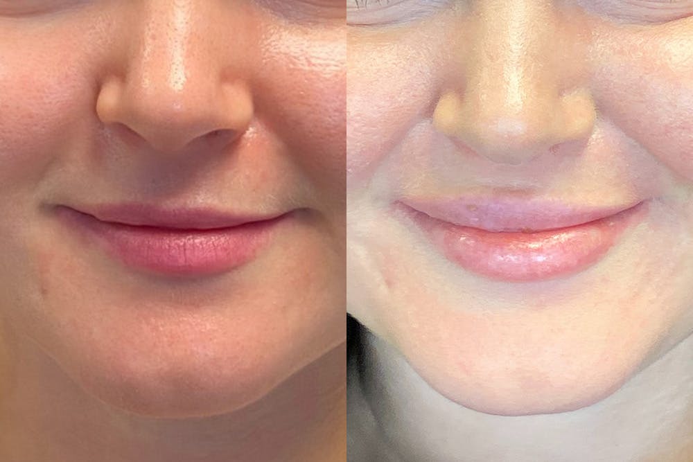 Dermal Fillers Before & After Gallery - Patient 144540724 - Image 1