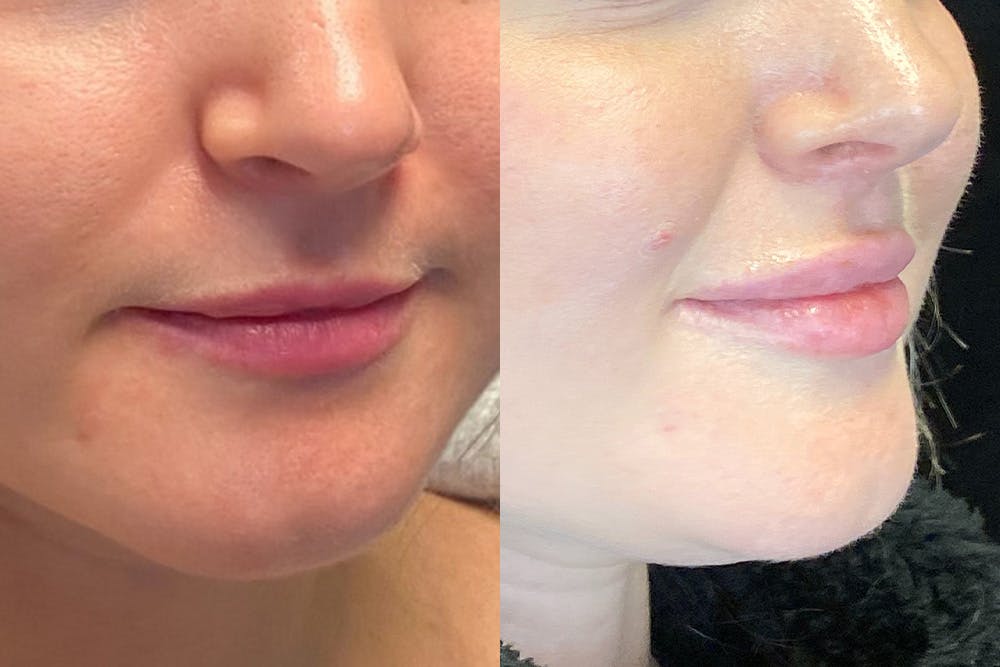 Dermal Fillers Before & After Gallery - Patient 144540724 - Image 2