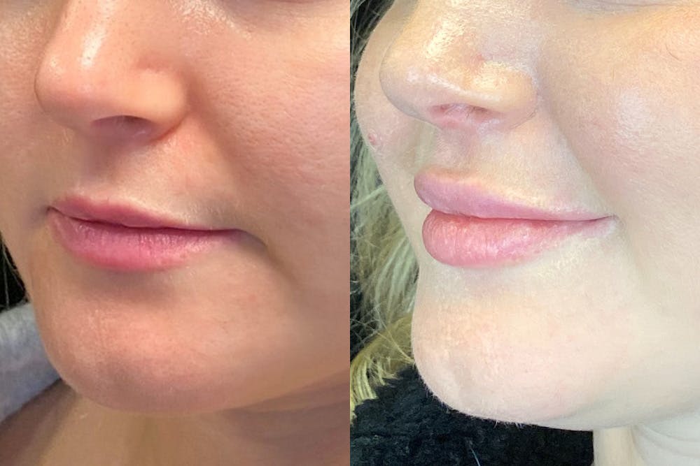 Dermal Fillers Before & After Gallery - Patient 144540724 - Image 3