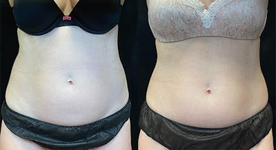SculpSure Before & After Gallery - Patient 146131529 - Image 1