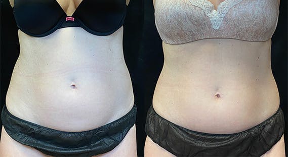 SculpSure Before & After Gallery - Patient 146131529 - Image 1