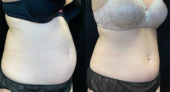SculpSure Before & After Gallery - Patient 146131529 - Image 2