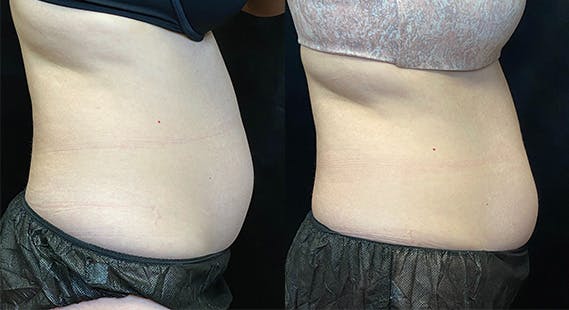 SculpSure Before & After Gallery - Patient 146131529 - Image 3