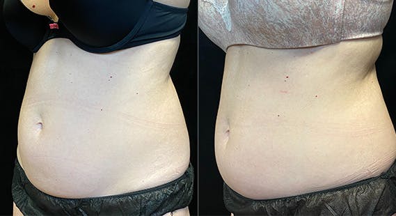 SculpSure Before & After Gallery - Patient 146131529 - Image 4