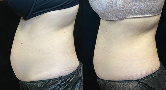 SculpSure Before & After Gallery - Patient 146131529 - Image 5