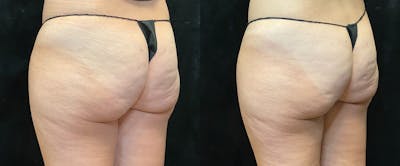 EvolveX Before & After Gallery - Patient 146194118 - Image 1
