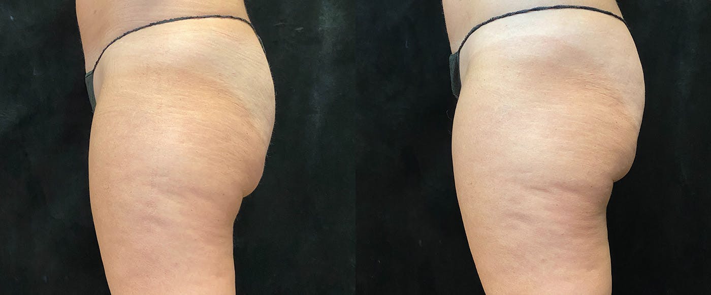 EvolveX Before & After Gallery - Patient 146194118 - Image 2