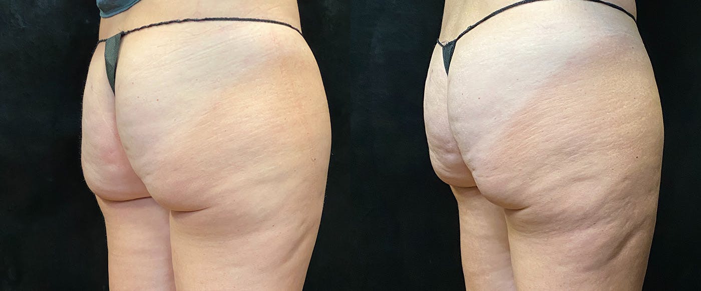 EvolveX Before & After Gallery - Patient 146194118 - Image 3