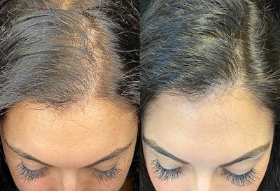 PRP Hair Restoration Before & After Gallery - Patient 154143463 - Image 1
