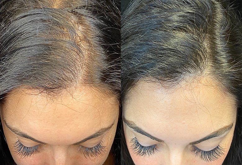 PRP Hair Restoration Before & After Gallery - Patient 154143463 - Image 1