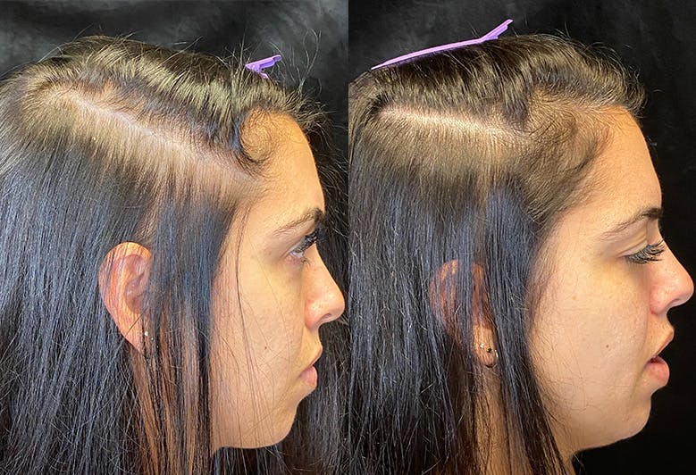 PRP Hair Restoration Before & After Gallery - Patient 154143463 - Image 2