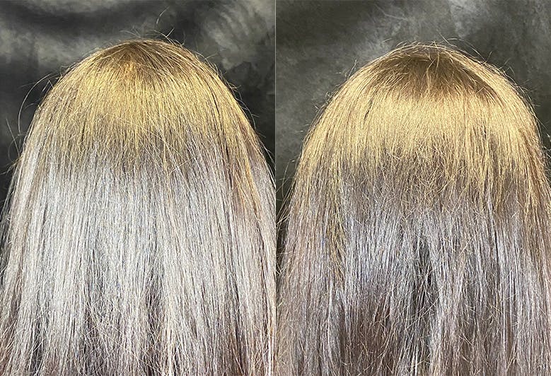 PRP Hair Restoration Before & After Gallery - Patient 154143463 - Image 4