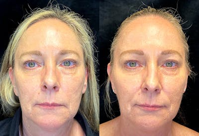 Dermal Fillers Before & After Gallery - Patient 146665653 - Image 1