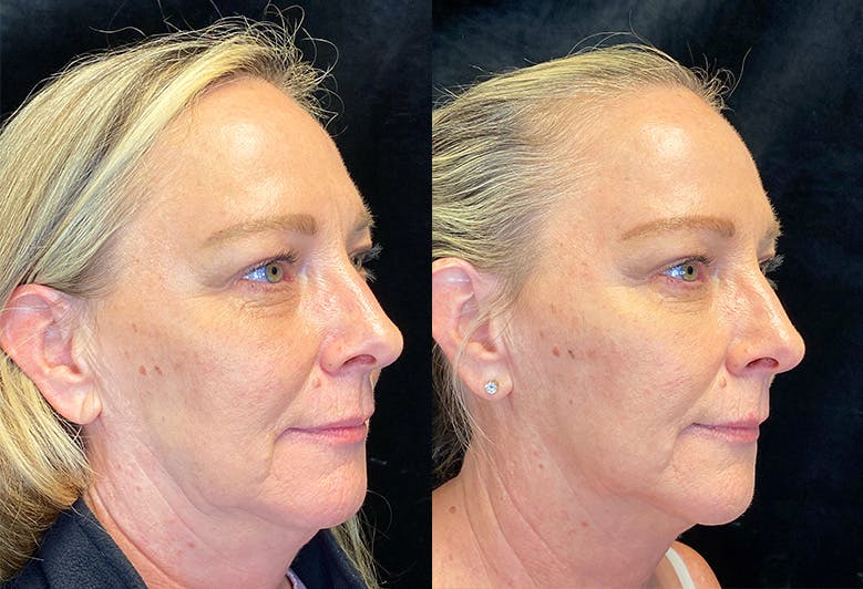 Dermal Fillers Before & After Gallery - Patient 146665653 - Image 2