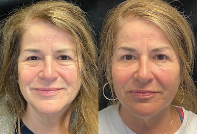 Dermal Fillers Before & After Gallery - Patient 146665656 - Image 1