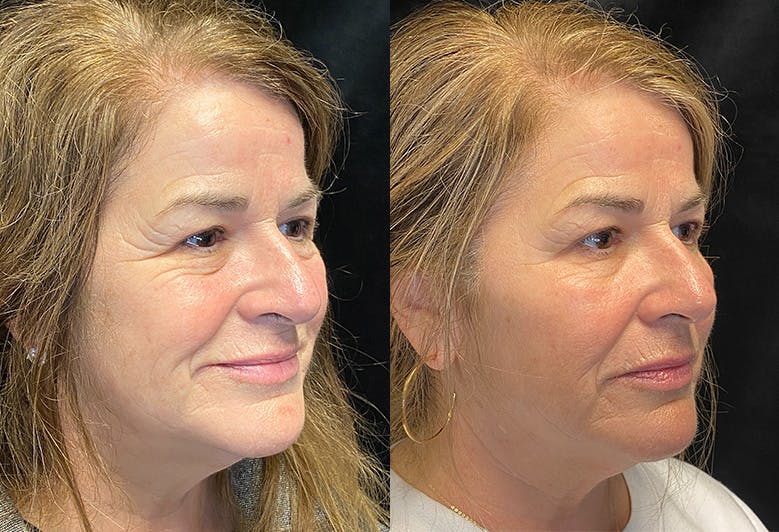 BOTOX/Dysport Before & After Gallery - Patient 146665670 - Image 2
