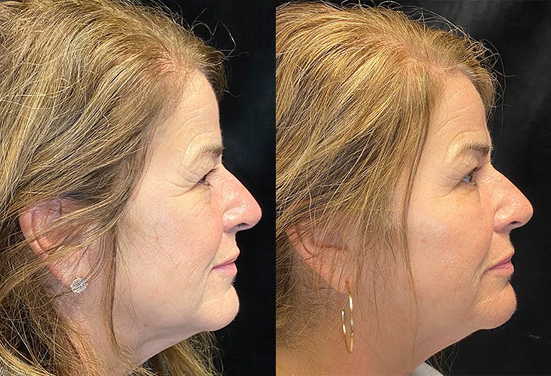 Dermal Fillers Before & After Gallery - Patient 146665656 - Image 3