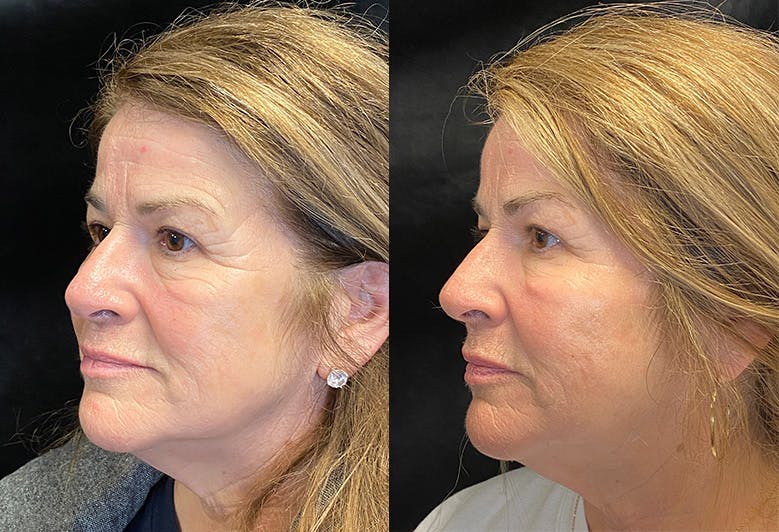 BOTOX/Dysport Before & After Gallery - Patient 146665670 - Image 4