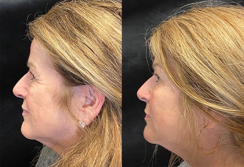 Dermal Fillers Before & After Gallery - Patient 146665656 - Image 5