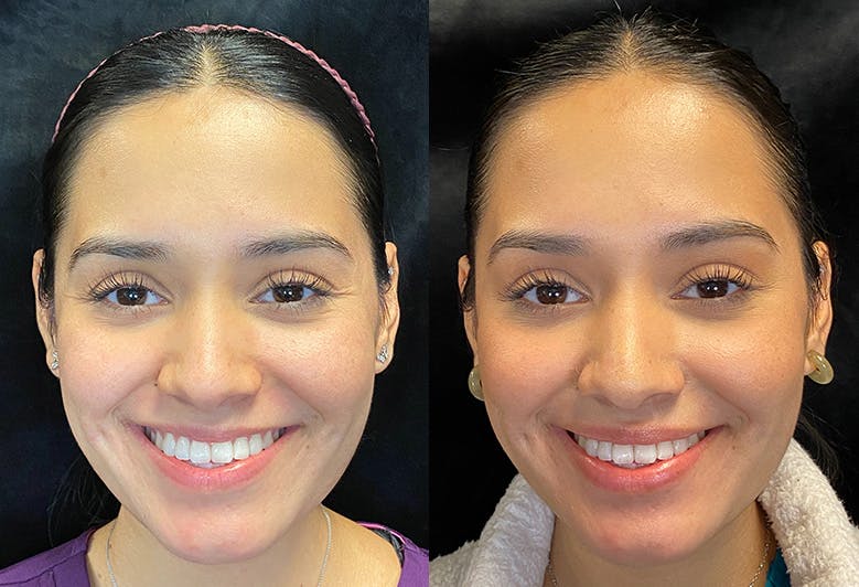 Dermal Fillers Before & After Gallery - Patient 146803816 - Image 1
