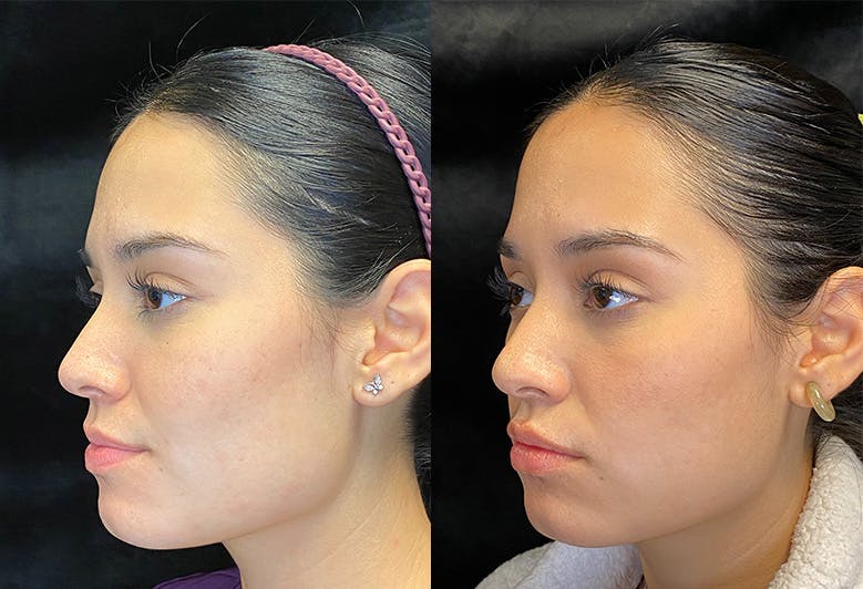 Dermal Fillers Before & After Gallery - Patient 146803816 - Image 2