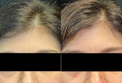 PRP Hair Restoration Before & After Gallery - Patient 154143460 - Image 1