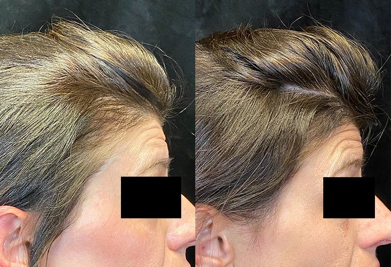 PRP Eye Rejuvenation Before & After Gallery - Patient 146804022 - Image 2