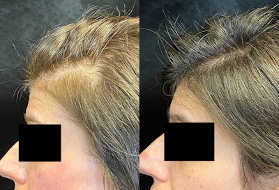PRP Hair Restoration Before & After Gallery - Patient 196949 - Image 1