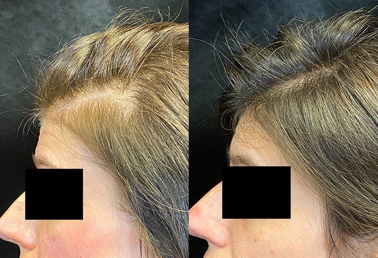 PRP Before & After Gallery - Patient 146804022 - Image 3