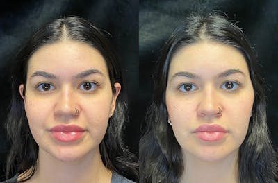 Evoke Before & After Gallery - Patient 147418315 - Image 1