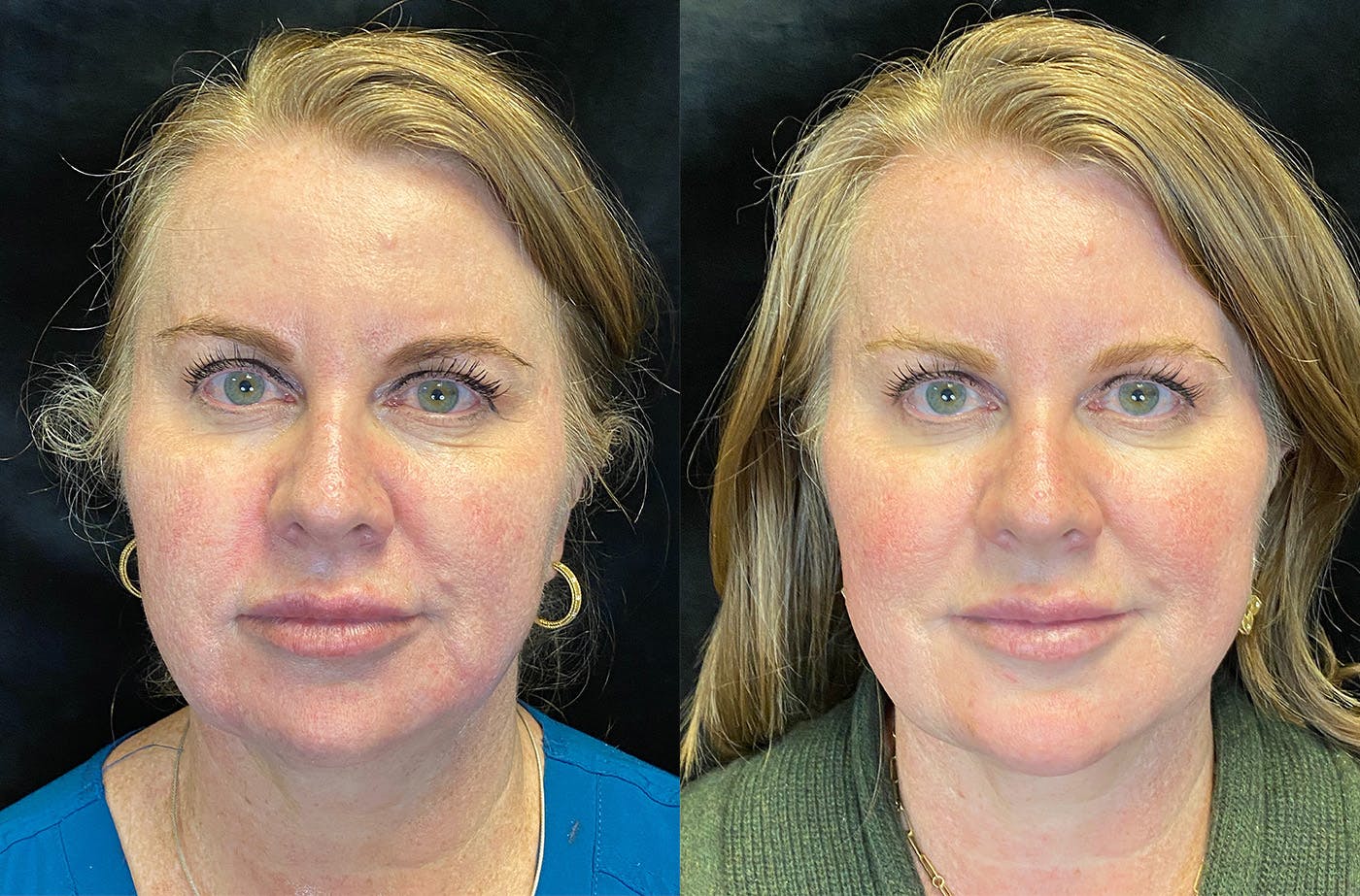 Dermal Fillers Before & After Gallery - Patient 147418371 - Image 1