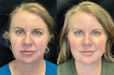 Dermal Fillers Before & After Gallery - Patient 147418371 - Image 1
