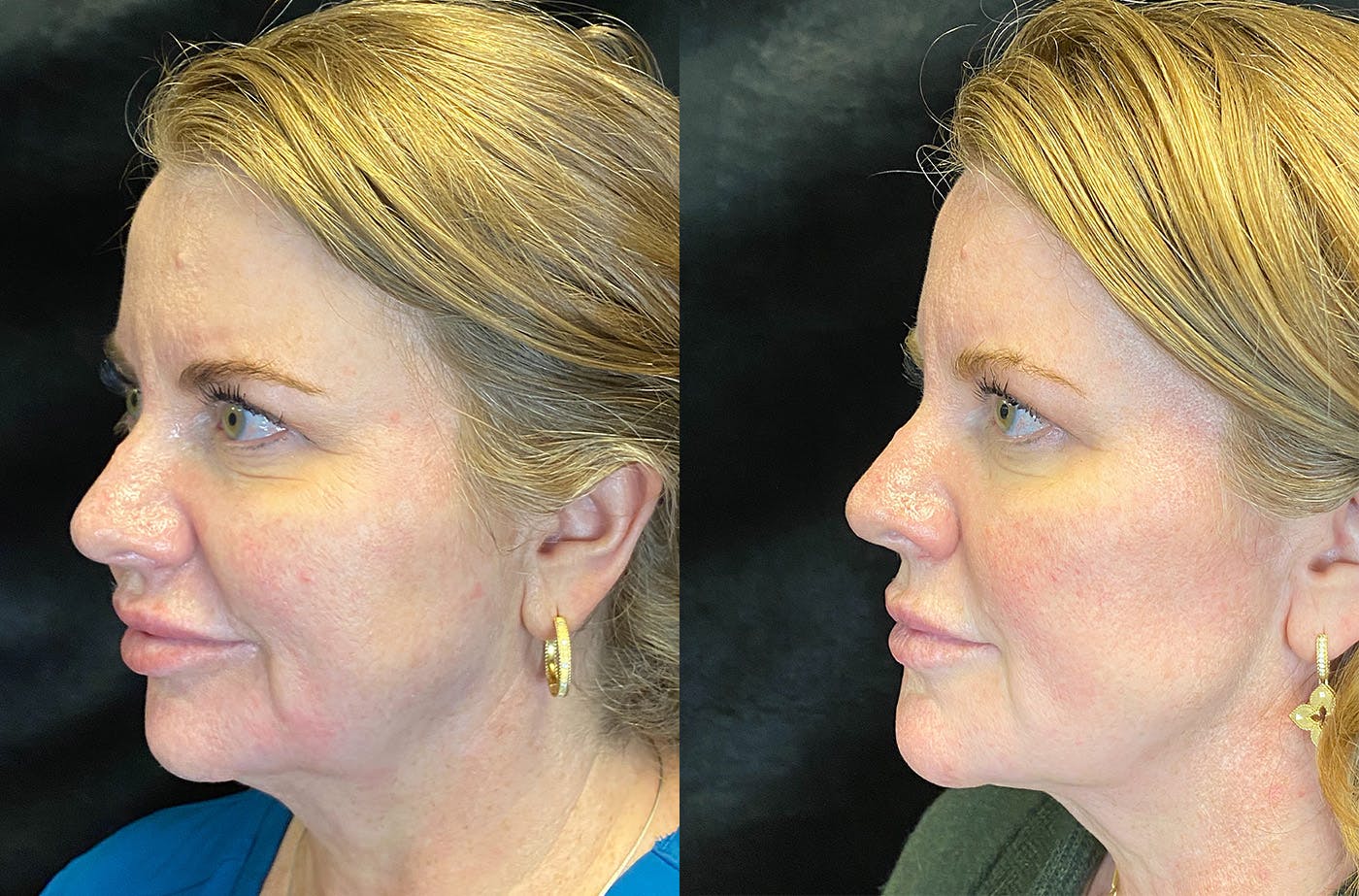 Dermal Fillers Before & After Gallery - Patient 147418371 - Image 2