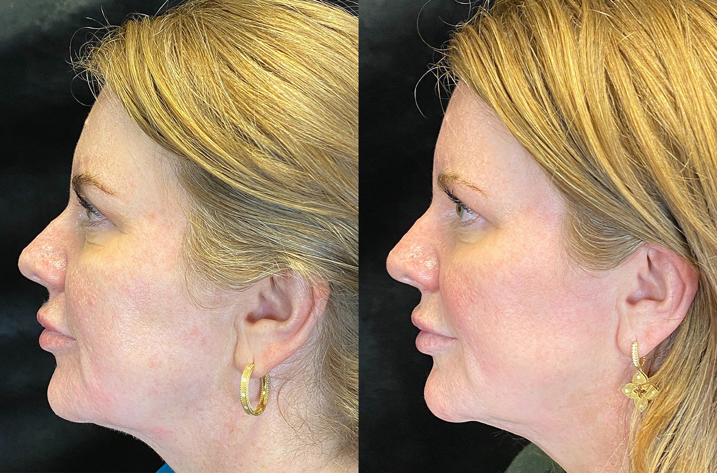 Dermal Fillers Before & After Gallery - Patient 147418371 - Image 3