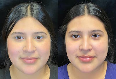 BOTOX/Dysport Before & After Gallery - Patient 147538012 - Image 1