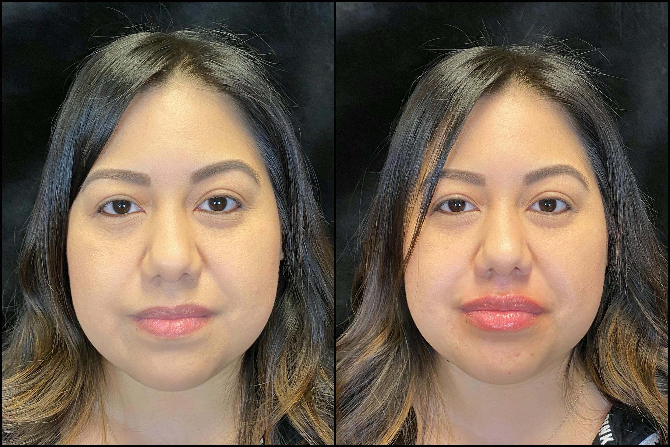 Dermal Fillers Before & After Gallery - Patient 147538034 - Image 2