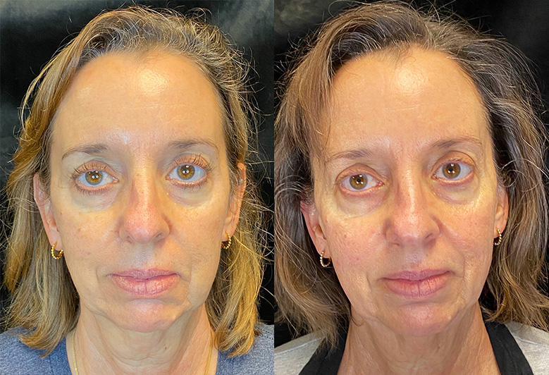 Patient 147538088 Morpheus8 Before & After Photos Modern Women's