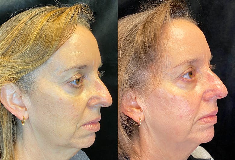 Morpheus8 Before & After Gallery - Patient 147538088 - Image 2