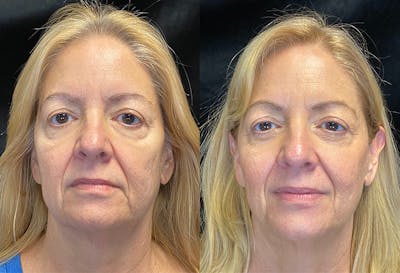 Morpheus8 Before & After Gallery - Patient 147538087 - Image 1