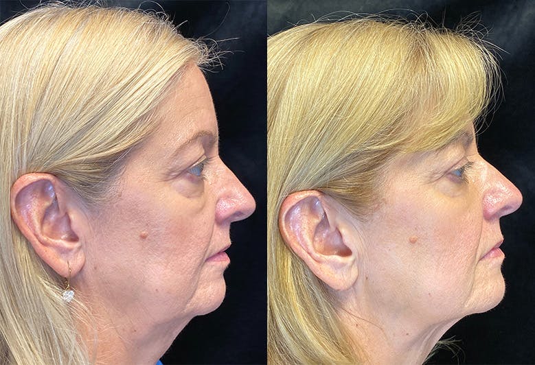 Morpheus8 Before & After Gallery - Patient 147538087 - Image 3