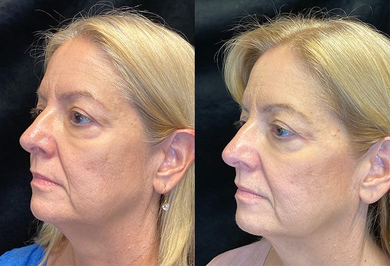 Morpheus8 Before & After Gallery - Patient 147538087 - Image 4