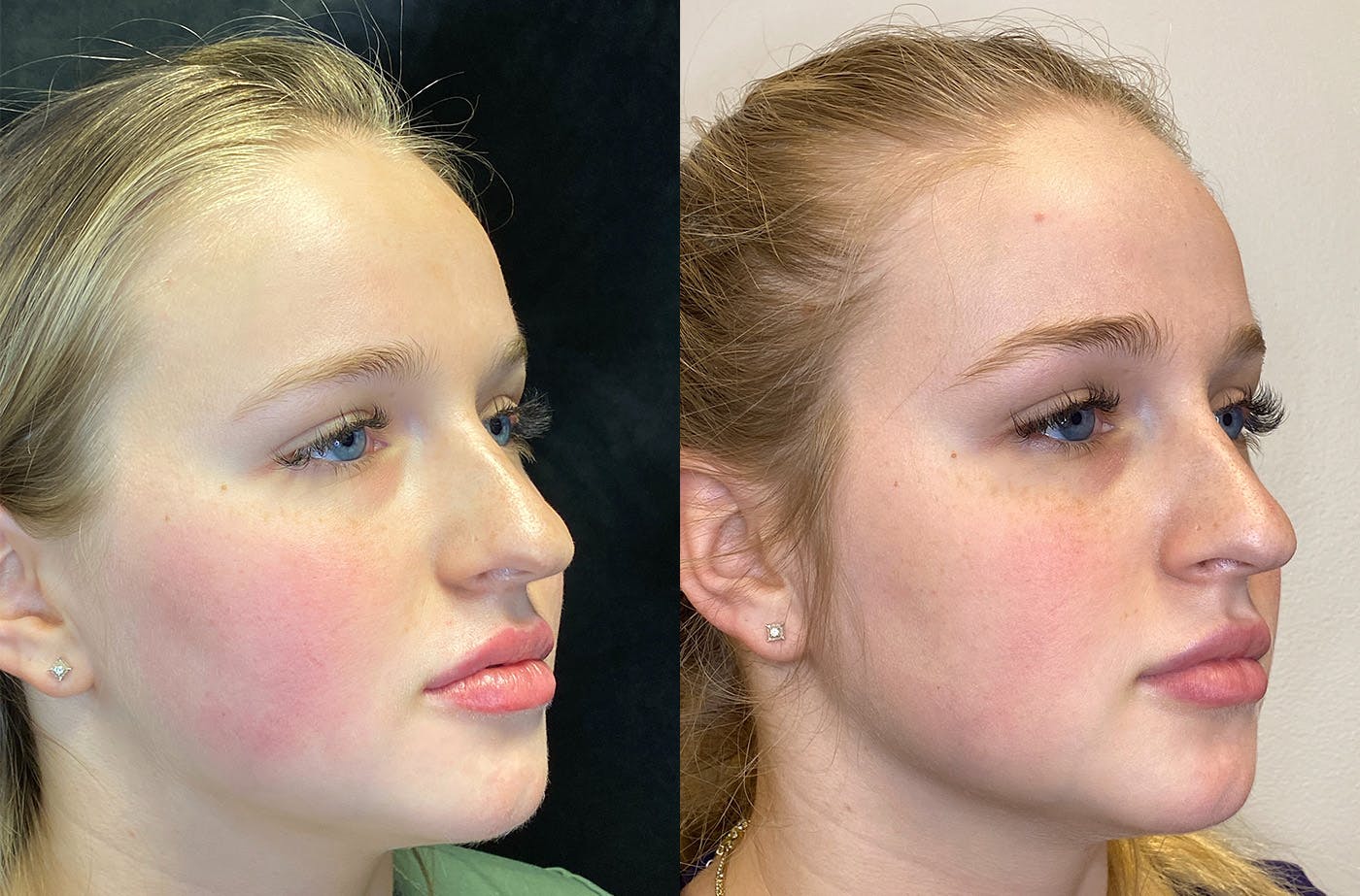 Dermal Fillers Before & After Gallery - Patient 147538360 - Image 2