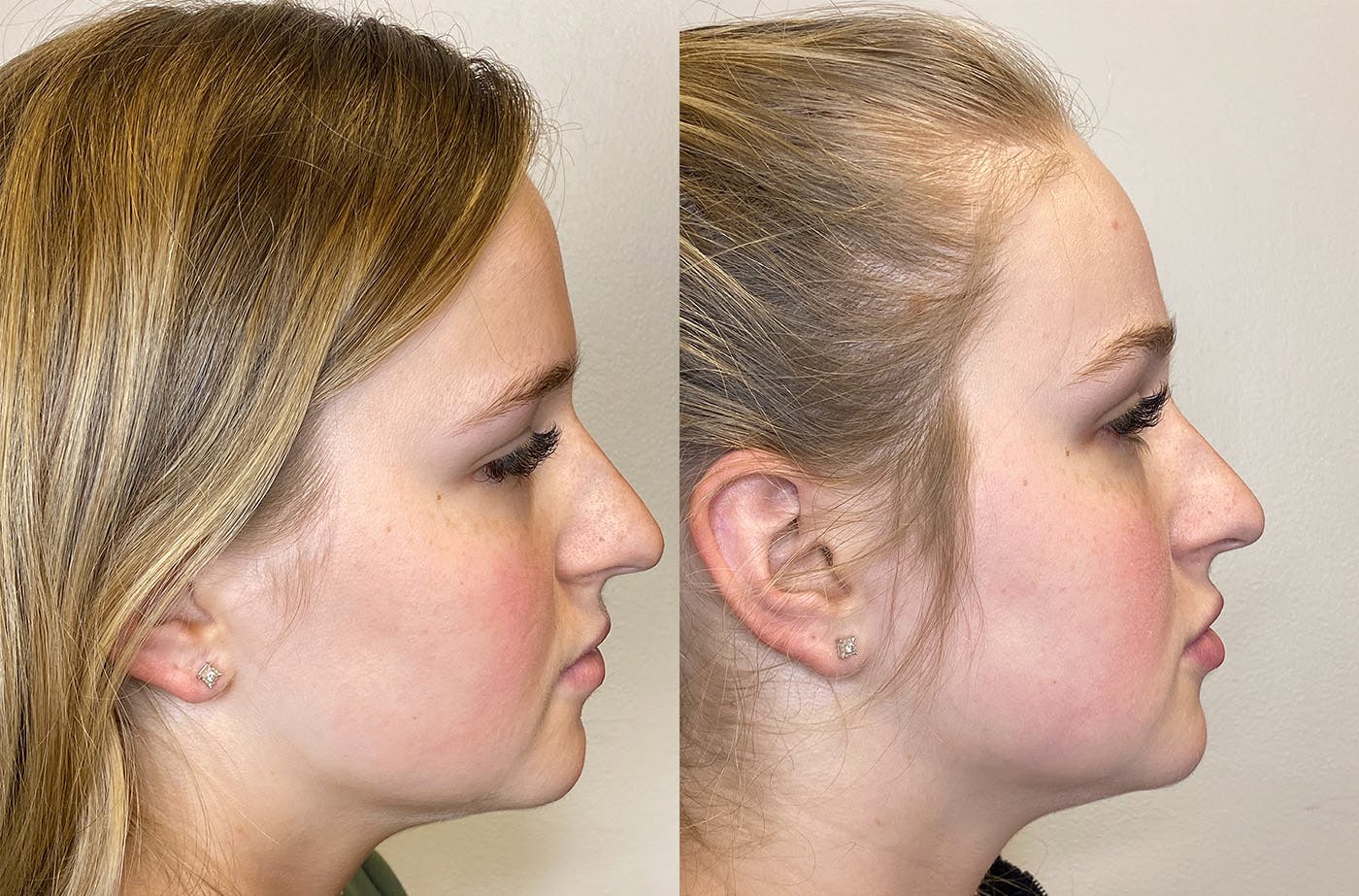 Dermal Fillers Before & After Gallery - Patient 147538360 - Image 3