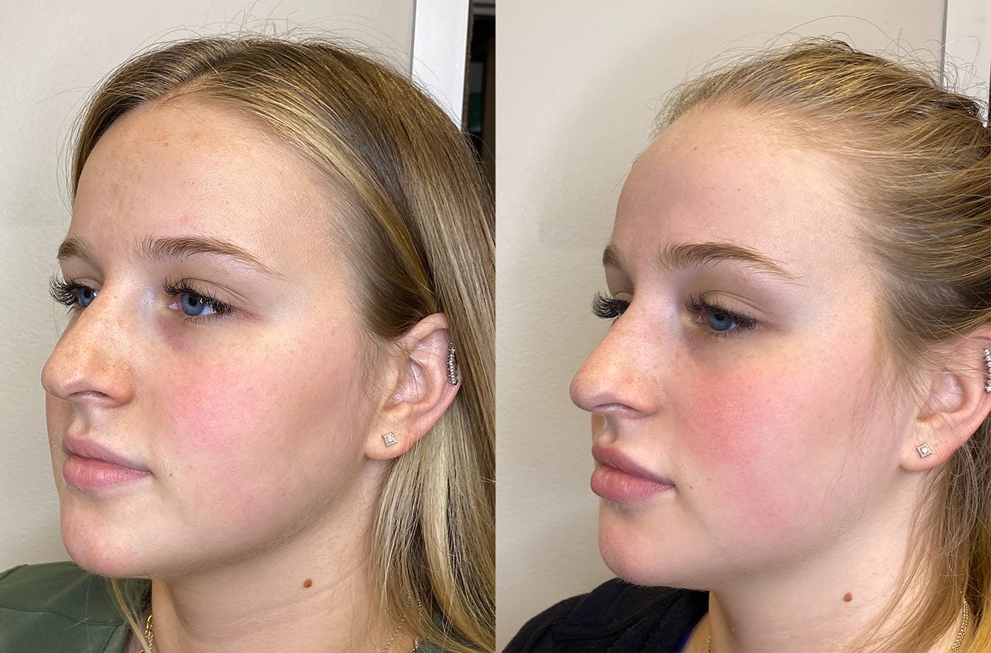 Dermal Fillers Before & After Gallery - Patient 147538360 - Image 4