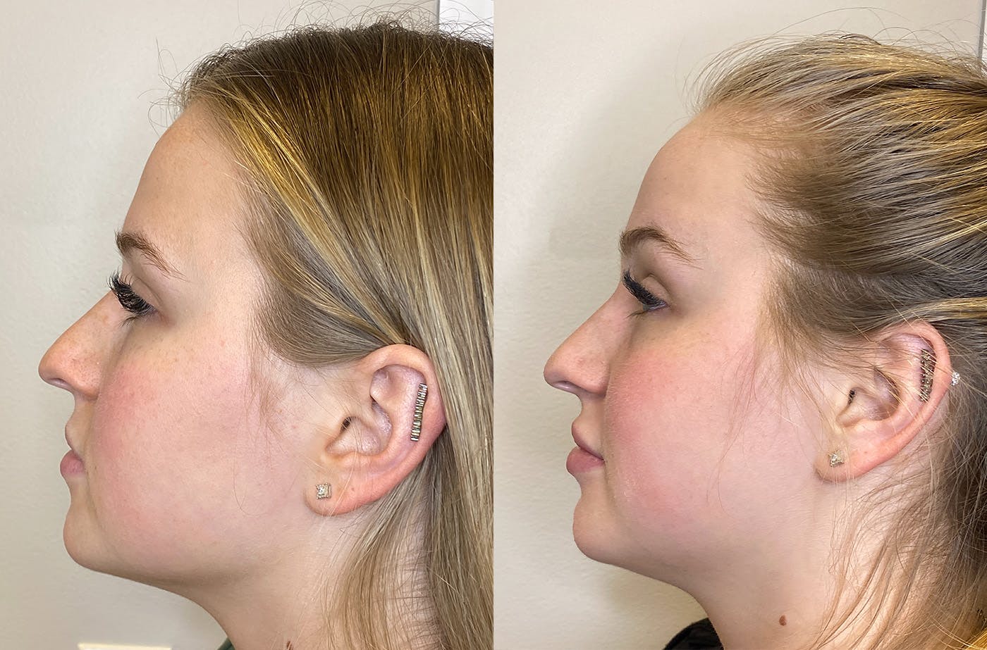 Dermal Fillers Before & After Gallery - Patient 147538360 - Image 5