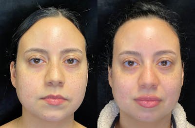 Dermal Fillers Before & After Gallery - Patient 147538369 - Image 1