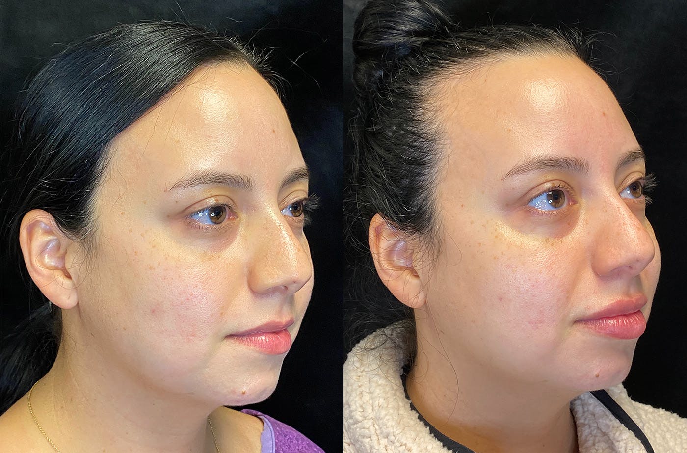 BOTOX/Dysport Before & After Gallery - Patient 147538370 - Image 2