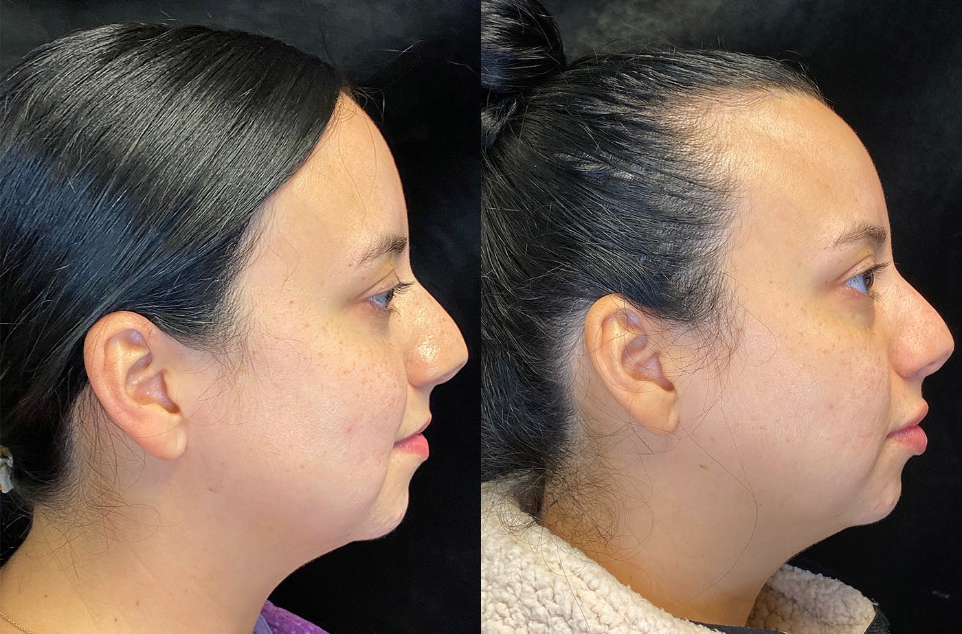 BOTOX/Dysport Before & After Gallery - Patient 147538370 - Image 3