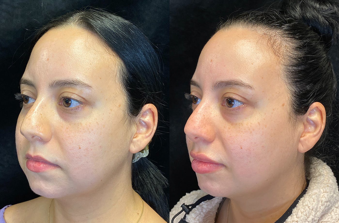 BOTOX/Dysport Before & After Gallery - Patient 147538370 - Image 4